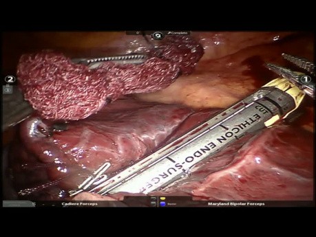 Segmentectomie pulmonaire anatomique S3 assistée par robot