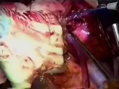 Transplantation Cardio-pulmonaire 