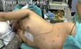 Splénectomie par laparoscopie