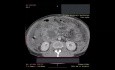 Tomodensitométrie abdominale à contraste amélioré chez le patient atteint de nécrose pancréatique isolée