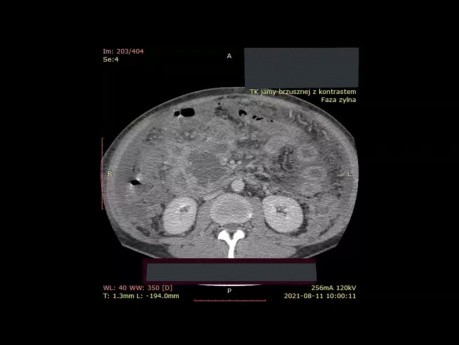 Tomodensitométrie abdominale à contraste amélioré chez le patient atteint de nécrose pancréatique isolée
