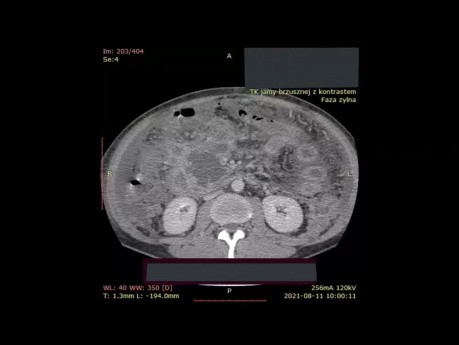 Tomodensitométrie abdominale à contraste amélioré chez le patient atteint de nécrose pancréatique isolée