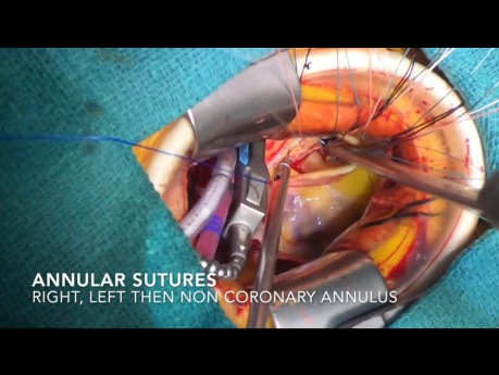 Remplacement de la valve aortique mini-invasif.