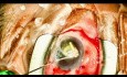 Remplacement de Lentille Intra-Oculaire (LIO) avec Fixation de Yamane, 1ère Partie