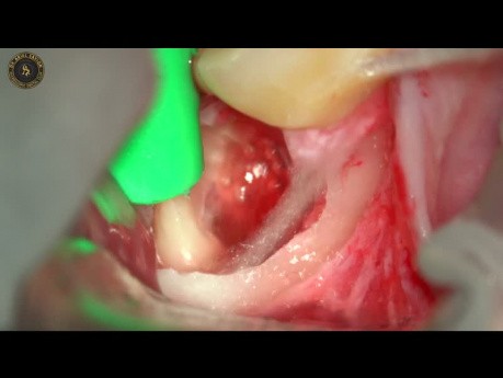 Extraction de dent de sagesse impactée sous microscope