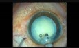 Capsulotomie à l'aide d'une lame de Fugo