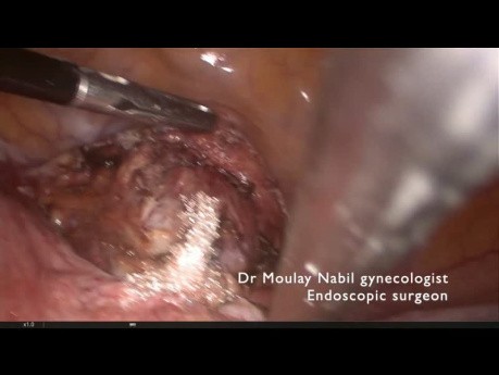 Cerclage cervico-isthmique laparoscopique