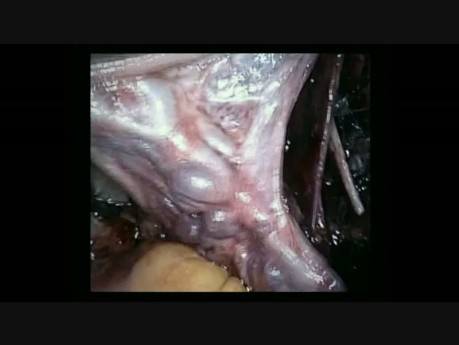 Hystérectomie Laparoscopique avec Curage Ganglionnaire pour Cancer de l'Endomètre