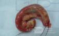 L' appendice avec ganglions lymphatiques