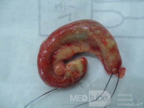 L' appendice avec ganglions lymphatiques
