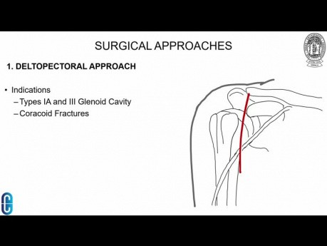 Fractures de l'omoplate