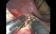Chirurgie trans-anale mini-invasive dans le traitement de la tumeur carcinoïde du rectum