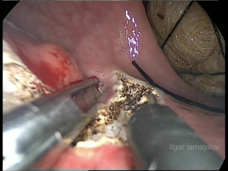 Chirurgie trans-anale mini-invasive dans le traitement de la tumeur carcinoïde du rectum