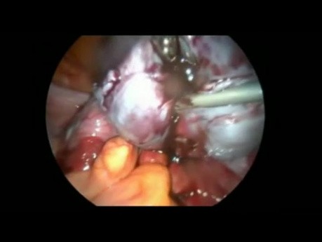 Endométriose de stade 4 - chirurgie laparoscopique