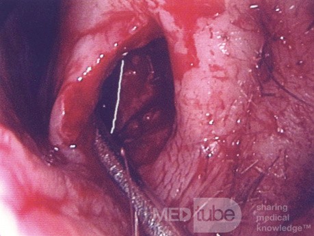 Le Syndrome du Nez Vide (SNV) - implant de paroi latérale
