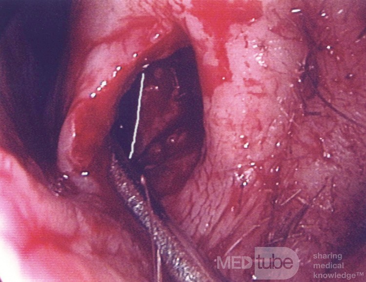 Le Syndrome du Nez Vide (SNV) - implant de paroi latérale