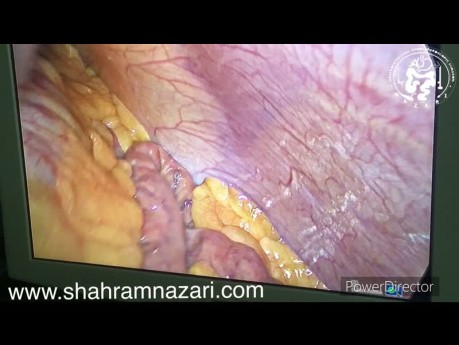 Pneumatose Intestinale