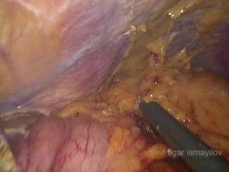 Gastrectomie Totale Laparoscopique pour Récidive sur l'Estomac Restant Après une Gastrectomie Partielle Ouverte