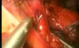 Fundoplicature de Nissen pour hernie hiatale