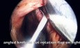 Réparation de perforation septale nasale