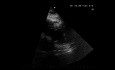 ECG et échocardiographie en cas de dyskinésie de la paroi ventriculaire gauche