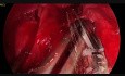 Lobectomie Inférieure Gauche Par Thoracoscopie Uniportale Sans Intubation