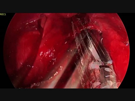 Lobectomie Inférieure Gauche Par Thoracoscopie Uniportale Sans Intubation