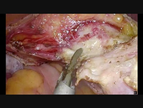 Hystérectomie totale par laparoscopie après 2 césariennes,  présence d'adhérences vésicales, dissection propre.