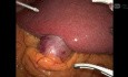 Cholécystectomie Robotique, ICG, CPE pour Cholécystite Aiguë