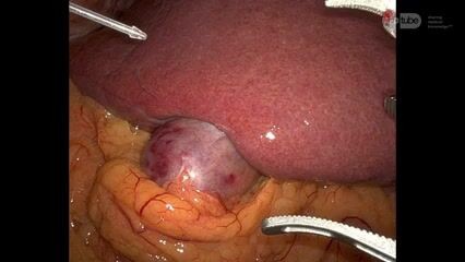 Cholécystectomie Robotique, ICG, CPE pour Cholécystite Aiguë
