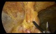 Cure de diastasis + hernie omblilicale en pariétoscopie