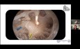 Anatomie de la Fenêtre Cochléaire et Implant Cochléaire Endosopique Assisté 