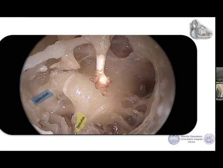 Anatomie de la Fenêtre Cochléaire et Implant Cochléaire Endosopique Assisté 