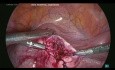Adénomyome kystique laparoscopique