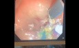 Ampullectomie 