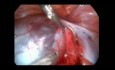 Ablation du kyste paratubaire par voie laparoscopique