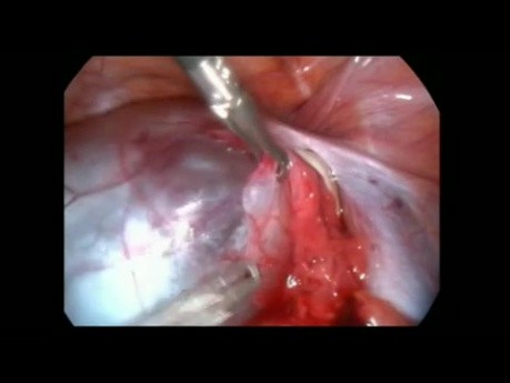 Ablation du kyste paratubaire par voie laparoscopique