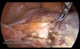 Directive ESGE sur l'hystérectomie laparoscopique totale