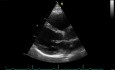 L'échocardiographie 3D en temps réel - vue à long axe parasternal de la valve mitrale (VM) , vidéo n ° 2