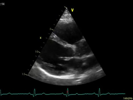 L'échocardiographie 3D en temps réel - vue à long axe parasternal de la valve mitrale (VM) , vidéo n ° 2