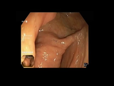 Intussusception de l'appendice.