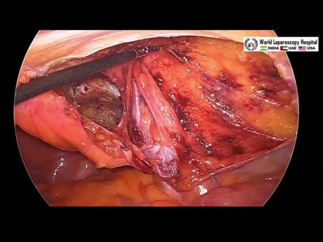 Réparation TAPP laparoscopique de la hernie inguinale indirecte