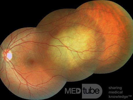 Une métastase du cancer du poumon au globe oculaire.