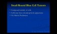Cours d'oncologie orthopédique - Tumeurs à petites cellules rondes bleues (sarcome d'Ewing, lymphome) - Conférence 8