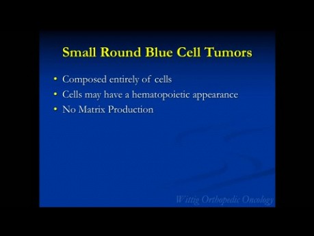 Cours d'oncologie orthopédique - Tumeurs à petites cellules rondes bleues (sarcome d'Ewing, lymphome) - Conférence 8