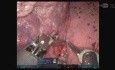 Segmentectomie Anatomique Supérieure Gauche Robotisée Uniportale (URATS) S1-2