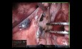 Segmentectomie pulmonaire S6, chirurgie assistée par robot
