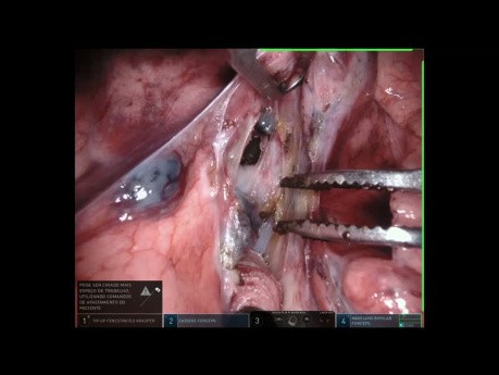 Segmentectomie pulmonaire S6, chirurgie assistée par robot