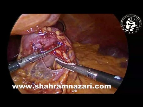 Cholécystectomie Concomitante pendant une Gastrectomie Sleeve Laparoscopique