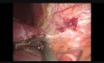 Résection hépatique par laparoscopie